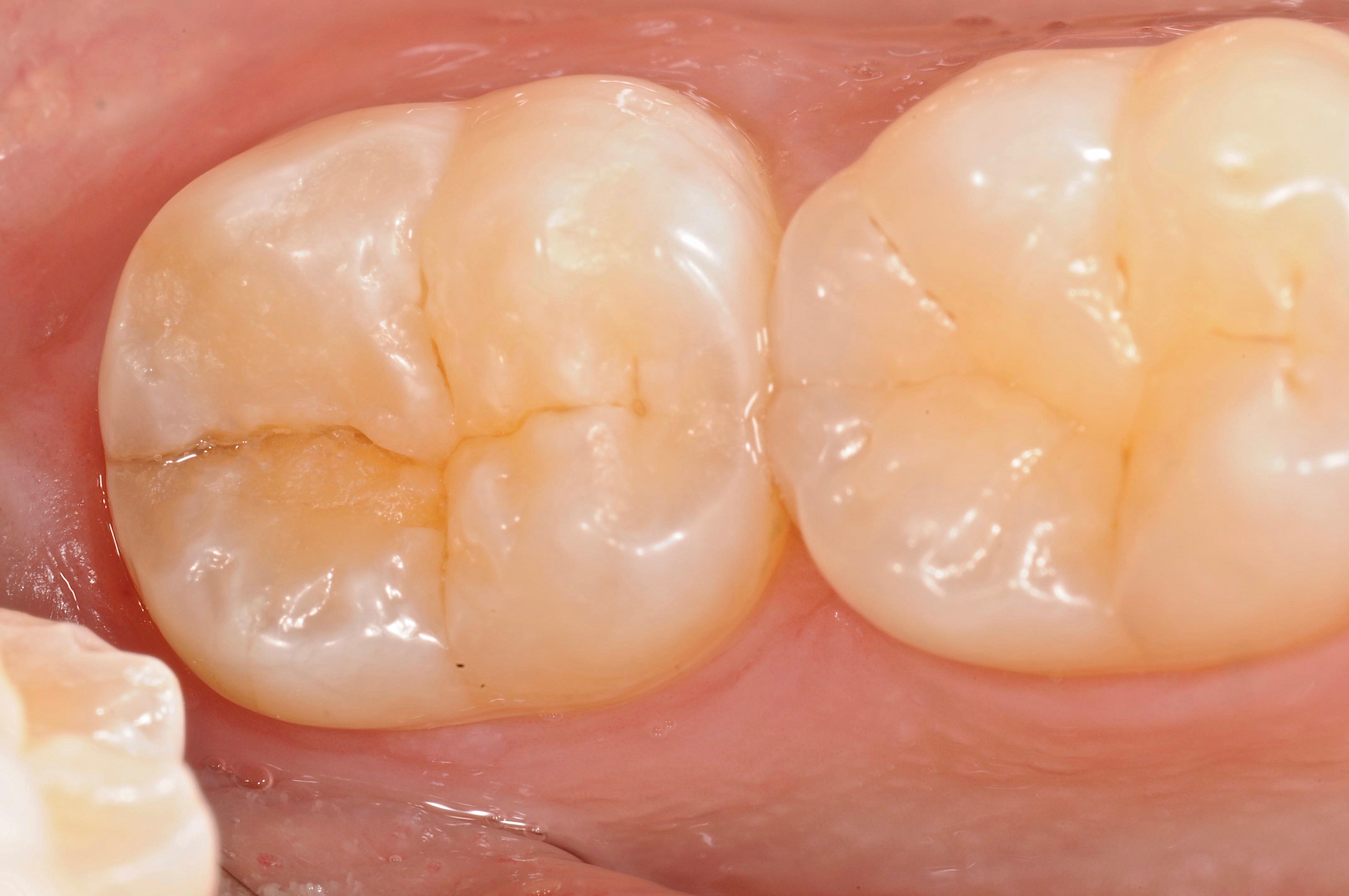 Cerec Crowns
