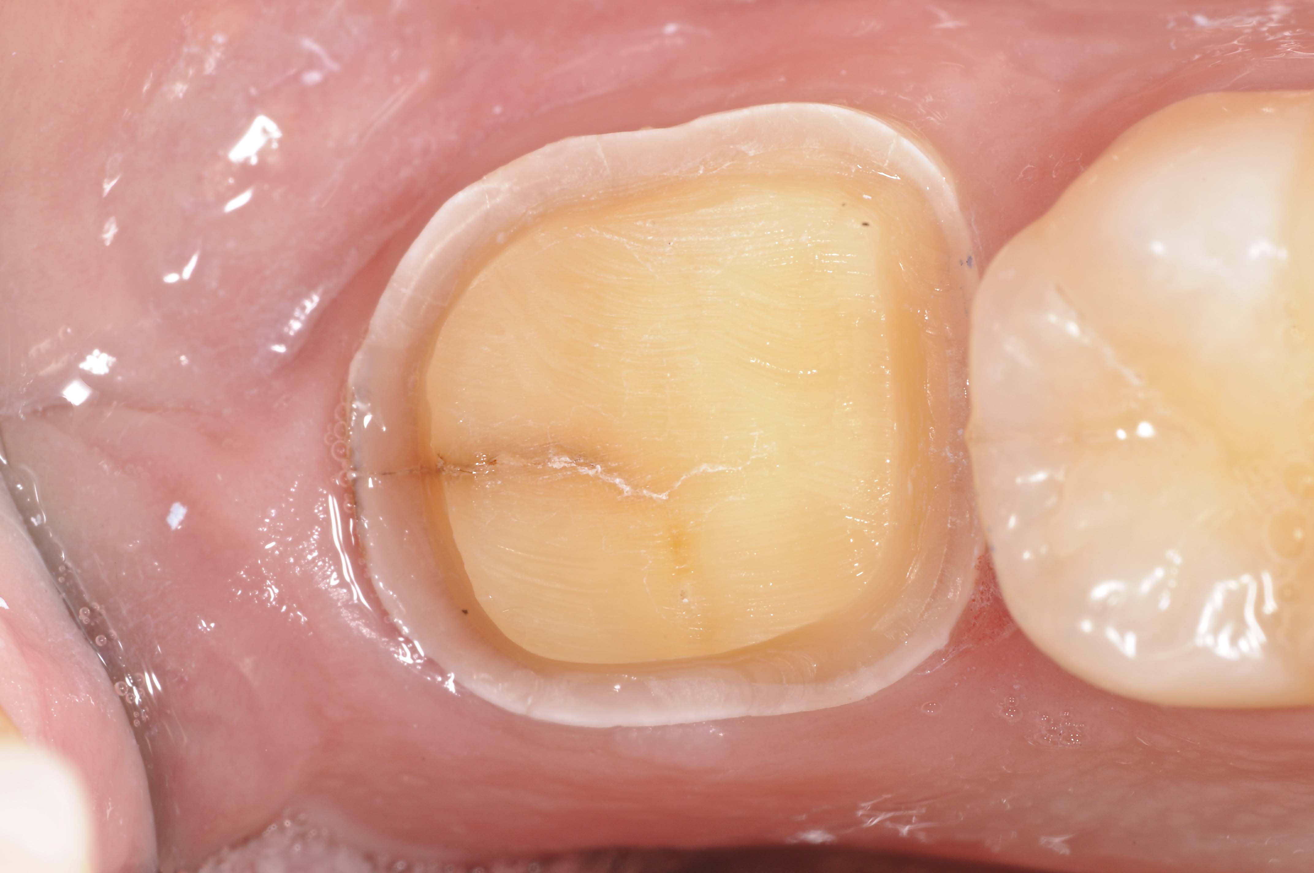 Cerec Crowns