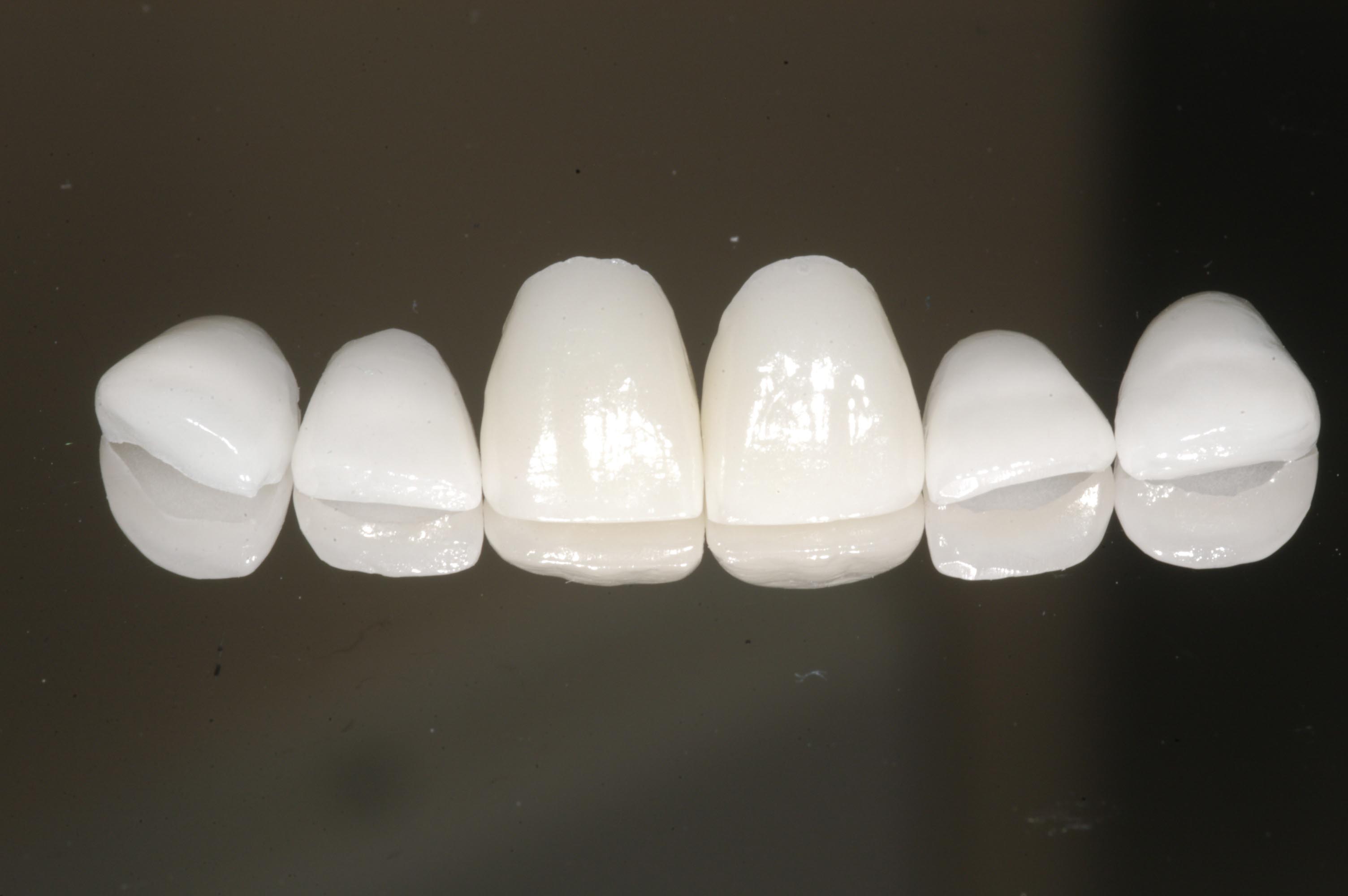 Veneers image